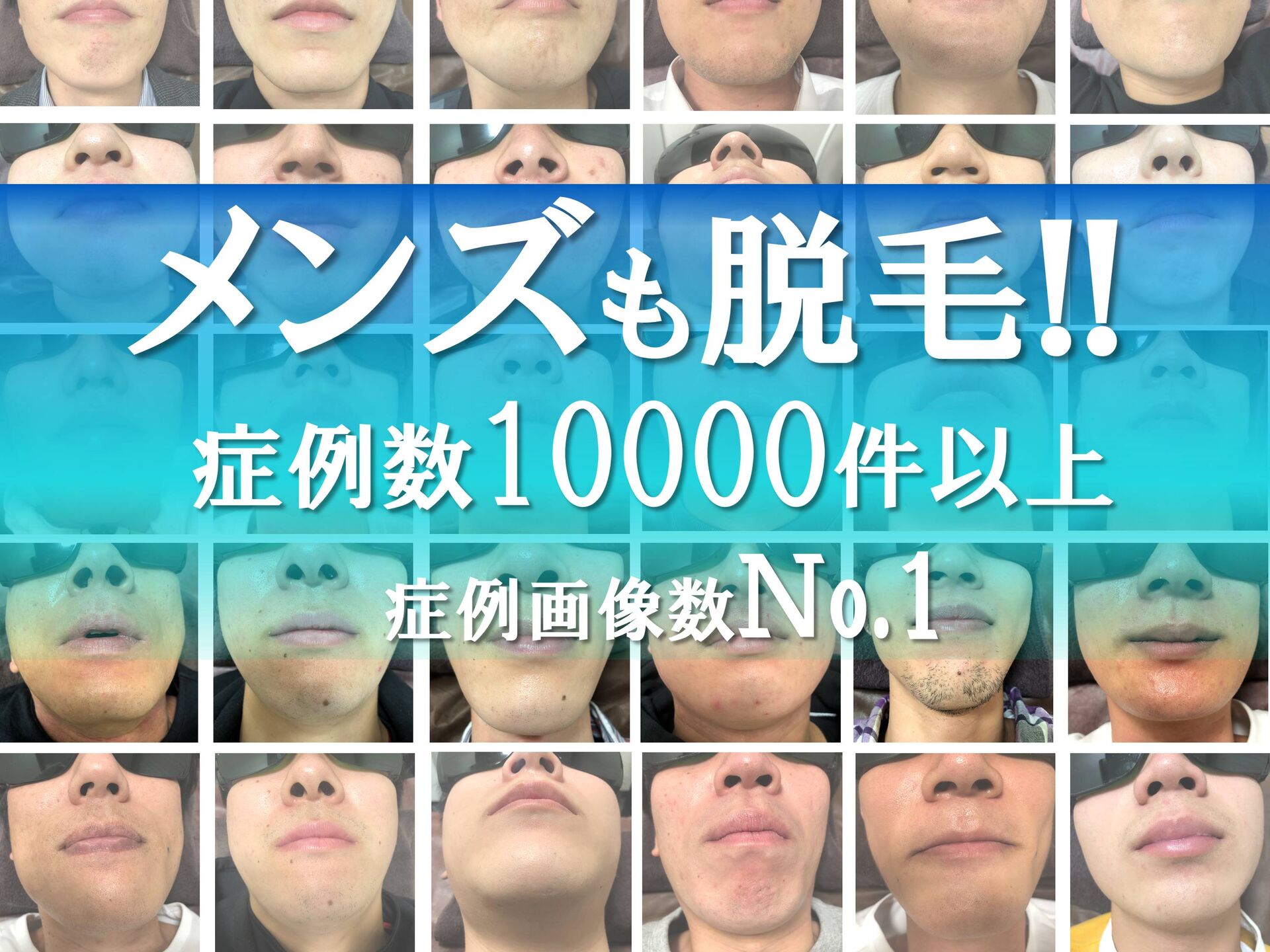 症例写真　メンズ脱毛　ヒゲ脱毛　ビフォーアフター