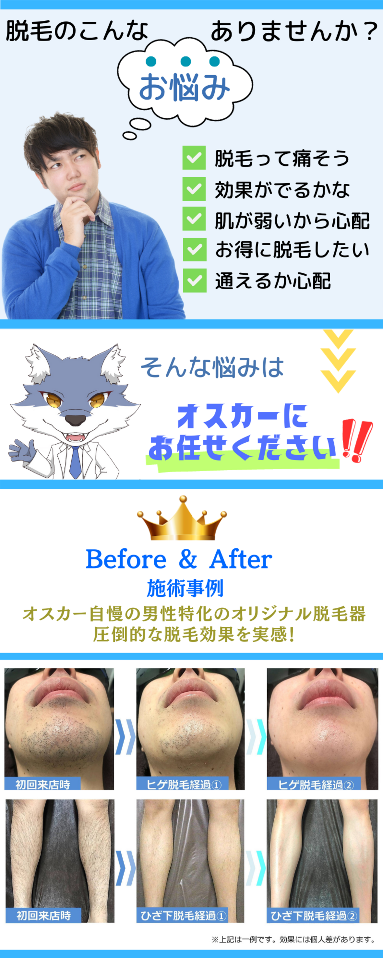 ヒゲ脱毛　メンズ脱毛　症例写真